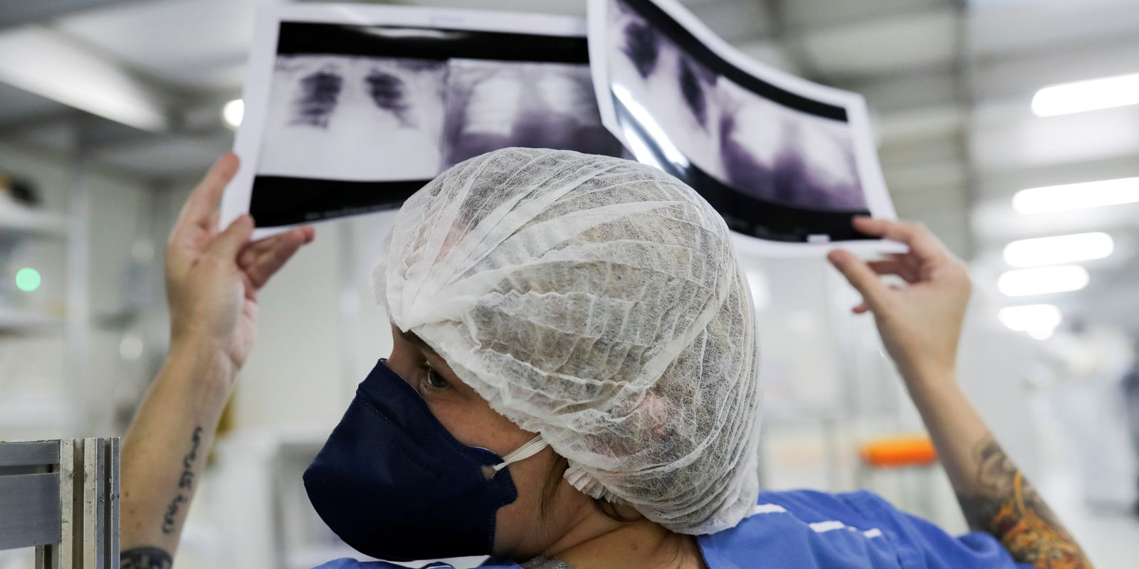 Diagnósticos tardios deixam 90% dos casos de câncer de pulmão em estágios avançados