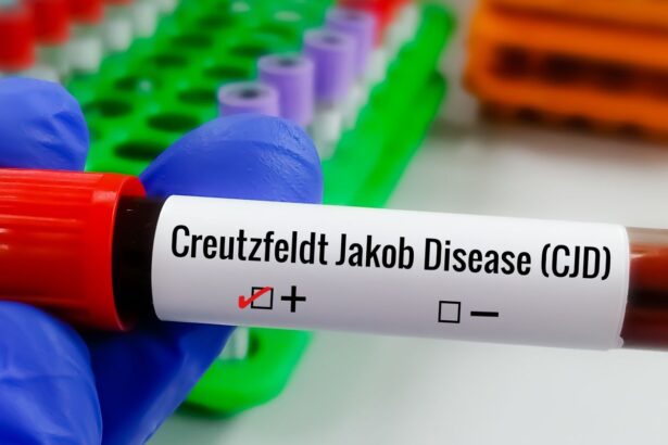 Pesquisadores intensificam busca por tratamento da Doença de Creutzfeldt-Jakob
