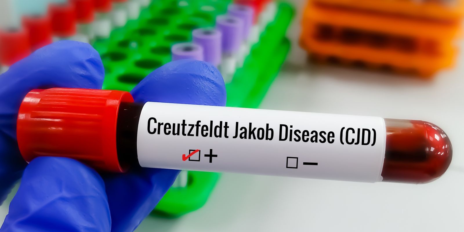 Pesquisadores intensificam busca por tratamento da Doença de Creutzfeldt-Jakob