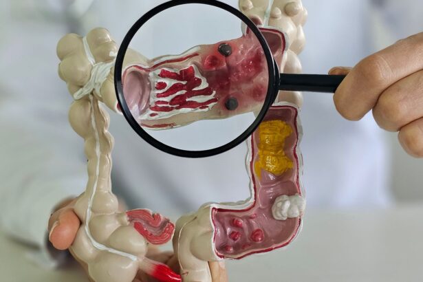 Casos de doenças inflamatórias intestinais quintuplicam no Brasil