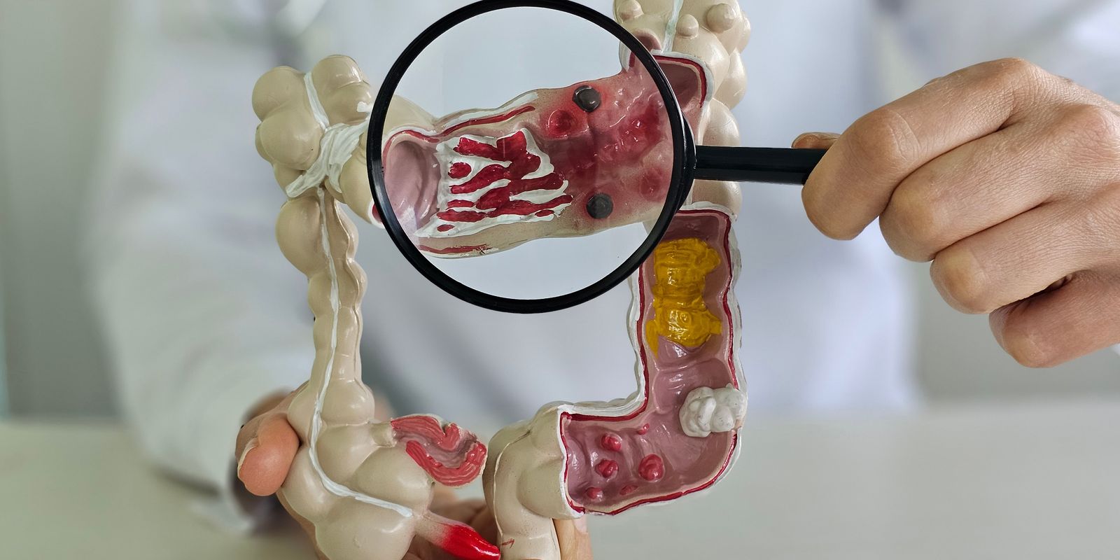Casos de doenças inflamatórias intestinais quintuplicam no Brasil